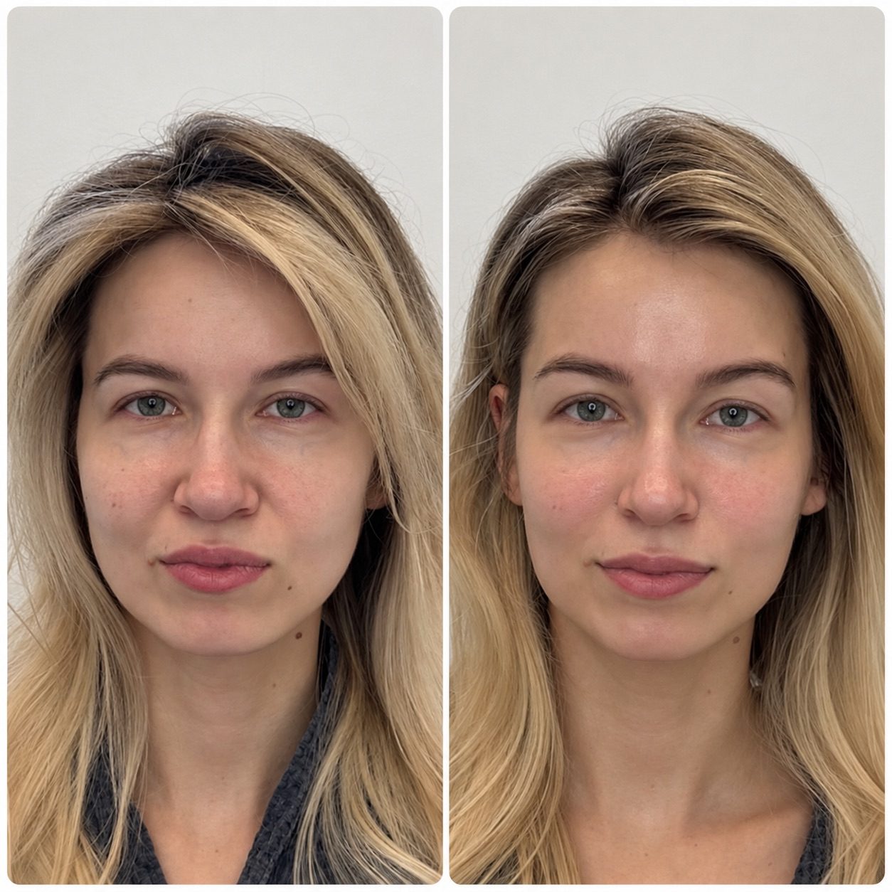 Client before and after facial massage sessions at ILM Wellness