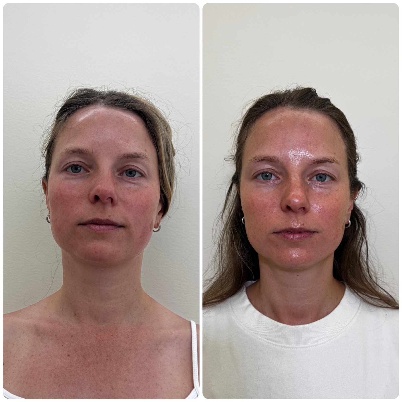 Client before and after a facial at ILM Wellness